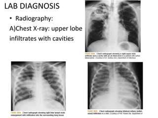 LAB DIAGNOSIS
• Radiography:
A)Chest X-ray: upper lobe
infiltrates with cavities
 