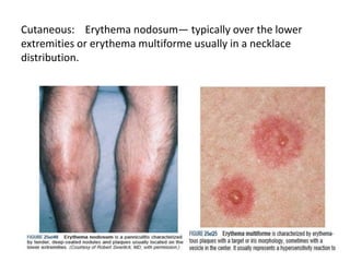 Cutaneous: Erythema nodosum— typically over the lower
extremities or erythema multiforme usually in a necklace
distribution.
 