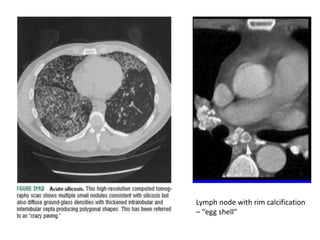 Lymph node with rim calcification
– ‘’egg shell”
 