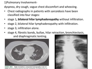 1)Pulmonary Involvement-
dyspnea, dry cough, vague chest discomfort and wheezing.
• Chest radiographs in patients with sarcoidosis have been
classified into four stages:
• stage 1, bilateral hilar lymphadenopathy without infiltration.
• stage 2, bilateral hilar lymphadenopathy with infiltration.
• stage 3, infiltration alone.
• stage 4, fibrotic bands, bullae, hilar retraction, bronchiectasis,
and diaphragmatic tenting.
 