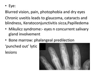 • Eye:
Blurred vision, pain, photophobia and dry eyes
Chronic uveitis leads to glaucoma, cataracts and
blindness, Keratoconjunctivitis sicca,Papilledema
• Mikulicz syndrome:- eyes n concurrent salivary
gland involvement
• Bone marrow: phalangeal predilection
‘punched out’ lytic
lesions
 