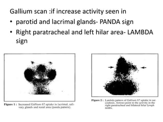 Gallium scan :if increase activity seen in
• parotid and lacrimal glands- PANDA sign
• Right paratracheal and left hilar area- LAMBDA
sign
 