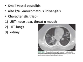 • Small vessel vasculitis
• also k/a Granulomatous Polyangitis
• Characteristic triad-
1) URT- nose , ear, throat n mouth
2) LRT-lungs
3) kidney
 