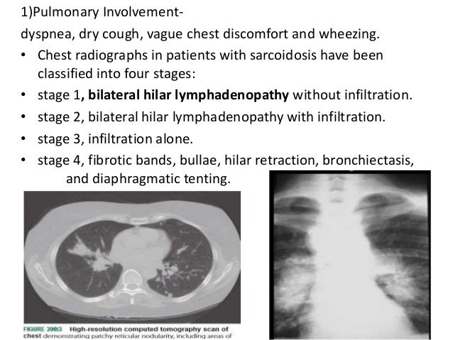 Tuberculosis mimics