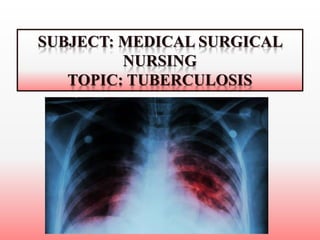 SUBJECT: MEDICAL SURGICAL
NURSING
TOPIC: TUBERCULOSIS
 