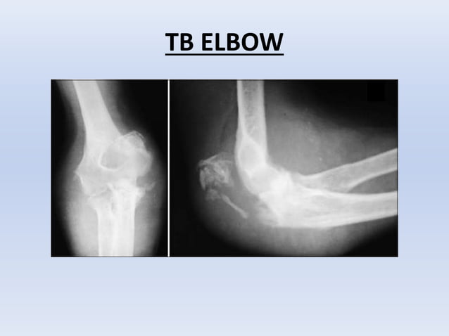 Tuberculosis Of Bone And Joints Ppt