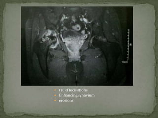  Fluid loculations
 Enhancing synovium
 erosions
 