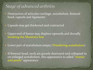  Destruction of articular cartilage, acetabulum, femoral
head, capsule and ligaments
 Capsule may get thickened and contracted
 Upper end of femur may displace upwards and dorsally
breaking the Shenton’s line
 Lower part of acetabulum empty (Wandering acetabulum)
 If femoral head, neck are grossly destroyed and collapsed in
on enlarged acetabulum, this appearance is called "mortar
and pestle" appearance
 