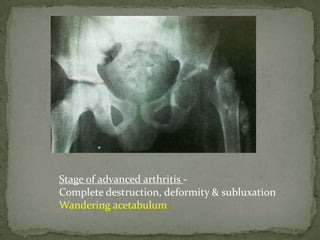 Stage of advanced arthritis -
Complete destruction, deformity & subluxation
Wandering acetabulum
 