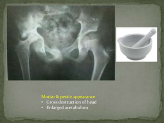 Mortar & pestle appearance
• Gross destruction of head
• Enlarged acetabulum
 