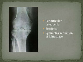  Periarticular
osteopenia
 Erosions
 Symmetric reduction
of joint space
 