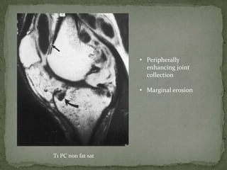 • Peripherally
enhancing joint
collection
• Marginal erosion
T1 PC non fat sat
 