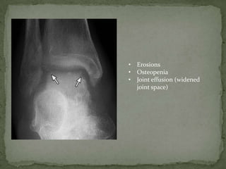 • Erosions
• Osteopenia
• Joint effusion (widened
joint space)
 