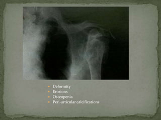  Deformity
 Erosions
 Osteopenia
 Peri-articular calcifications
 