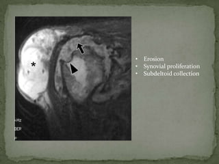 • Erosion
• Synovial proliferation
• Subdeltoid collection
 