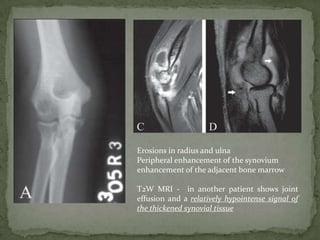 Erosions in radius and ulna
Peripheral enhancement of the synovium
enhancement of the adjacent bone marrow
T2W MRI - in another patient shows joint
effusion and a relatively hypointense signal of
the thickened synovial tissue
 