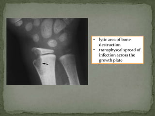 • lytic area of bone
destruction
• transphyseal spread of
infection across the
growth plate
 