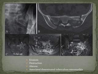  Erosions
 Destruction
 Abscess
 Associated disseminated tuberculous osteomyelitis
T1 fat sat
 