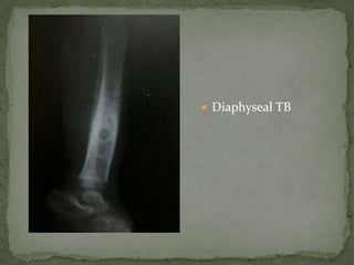  Diaphyseal TB
 