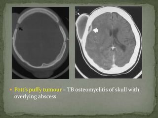  Pott’s puffy tumour – TB osteomyelitis of skull with
overlying abscess
 