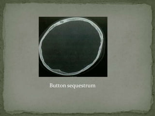 Button sequestrum
 