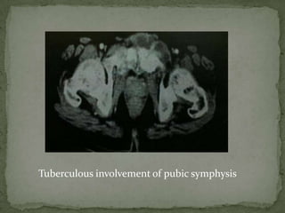 Tuberculous involvement of pubic symphysis
 