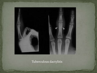 Tuberculous dactylitis
 