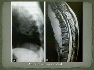 Anterior sub-periosteal
 
