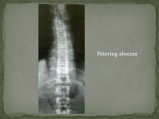 Petering abscess
 