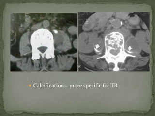  Calcification – more specific for TB
 
