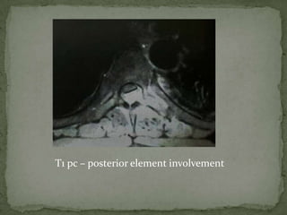 T1 pc – posterior element involvement
 
