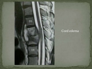 Cord edema
 