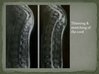 Thinning &
stretching of
the cord
 