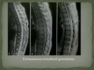 Extraosseous extradural granuloma
 