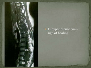  T1 hyperintense rim –
sign of healing
 