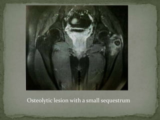 Osteolytic lesion with a small sequestrum
 