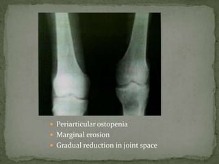  Periarticular ostopenia
 Marginal erosion
 Gradual reduction in joint space
 