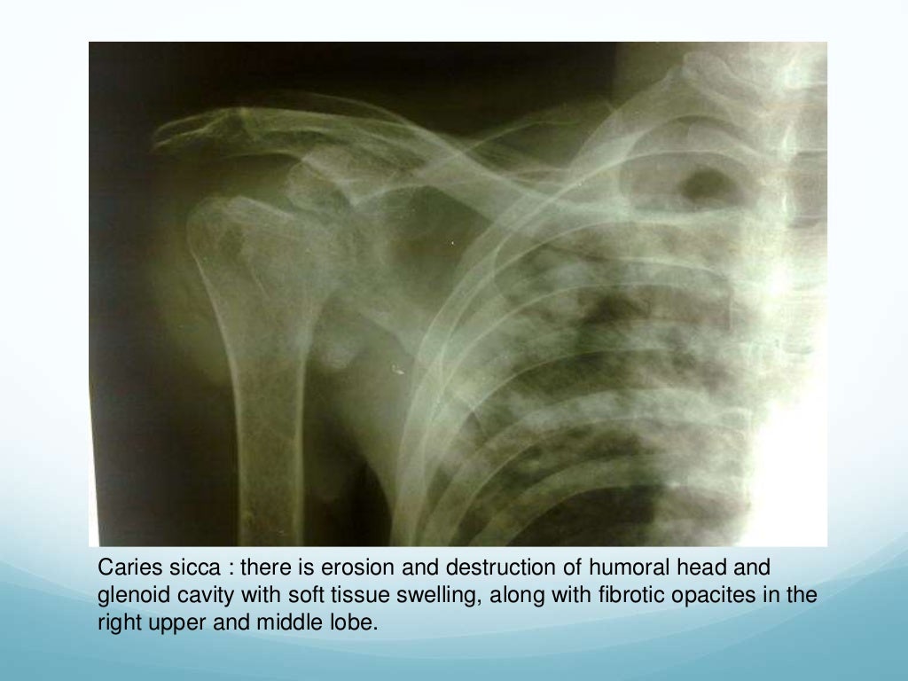Tuberculosis of bones and joints