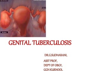 GENITAL TUBERCULOSIS
DR.G.SUDHARANI,
ASSTPROF,
DEPT OF OBGY,
GGH KURNOOL
 
