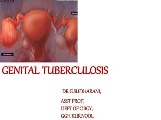 GENITAL TUBERCULOSIS
DR.G.SUDHARANI,
ASSTPROF,
DEPT OF OBGY,
GGH KURNOOL
 