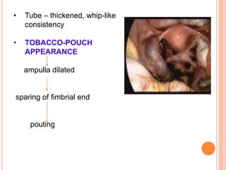 tobacco pouch appearance Tuberculosis of genital tract power point