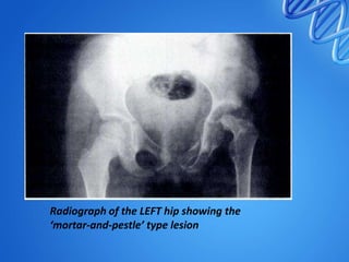 Radiograph of the LEFT hip showing the
‘mortar-and-pestle’ type lesion

 