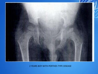 2 YEARS BOY WITH PERTHES TYPE DISEASE

 