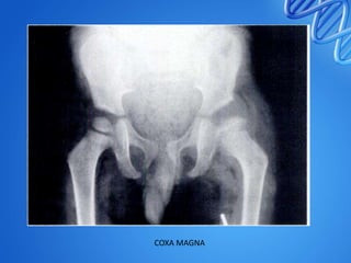 COXA MAGNA

 