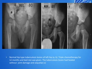 •

Normal hip type tuberculosis lesion of left hip (a, b). Triple chemotherapy for
12 months and bed rest was given. The tuberculosis lesion had healed
without joint damage and sequelae (c)

 