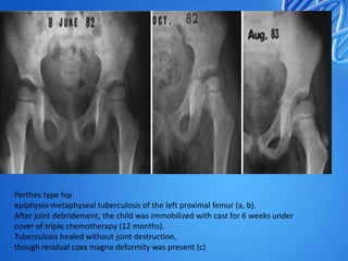 Perthes type hip
epiphysio-metaphyseal tuberculosis of the left proximal femur (a, b).
After joint debridement, the child was immobilized with cast for 6 weeks under
cover of triple chemotherapy (12 months).
Tuberculosis healed without joint destruction,
though residual coxa magna deformity was present (c)

 