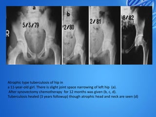 Atrophic type tuberculosis of hip in
a 11-year-old girl. There is slight joint space narrowing of left hip (a).
After synovectomy chemotherapy for 12 months was given (b, c, d).
Tuberculosis healed (3 years followup) though atrophic head and neck are seen (d)

 