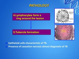 PATHOLOGY
4.Lymphocytes form a
ring around the lesion

5.Tubercle formation




Epitheloid cells-characteristic of TB.
Presence of caseation necrosis almost diagnostic of TB

 