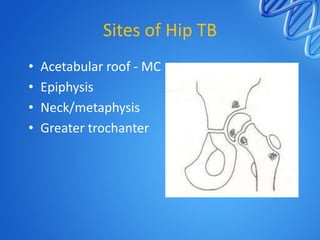 Sites of Hip TB
•
•
•
•

Acetabular roof - MC
Epiphysis
Neck/metaphysis
Greater trochanter

 
