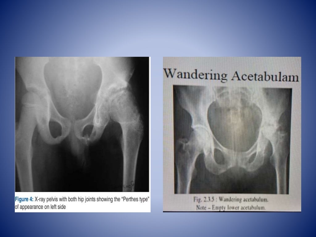 Tuberculosis of hip joint